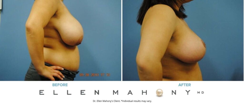 Before and After Image: Case #2629 - right-side