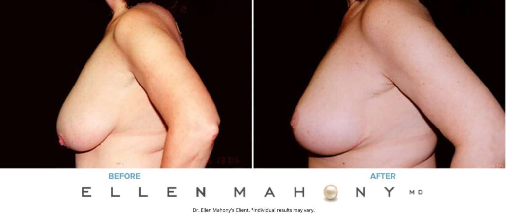 Before and After Image: Case #2636 - left-side