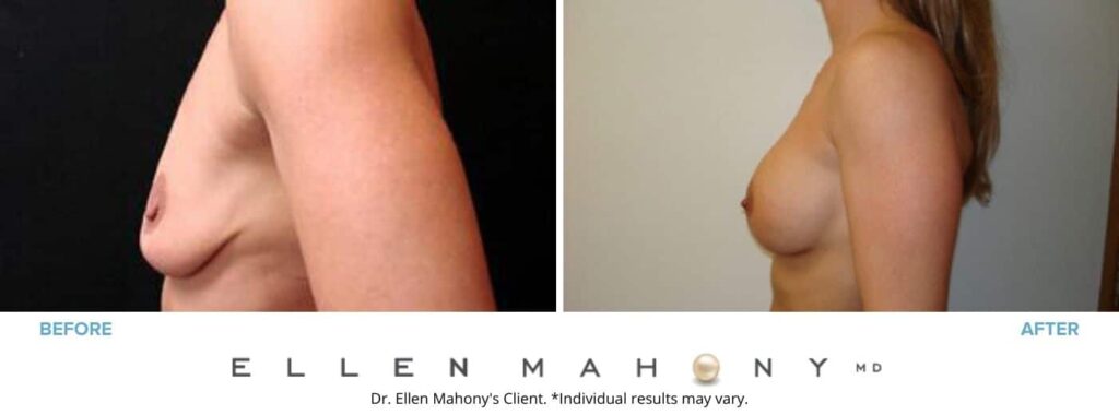 Before and After Image: Case #2696 - left-side