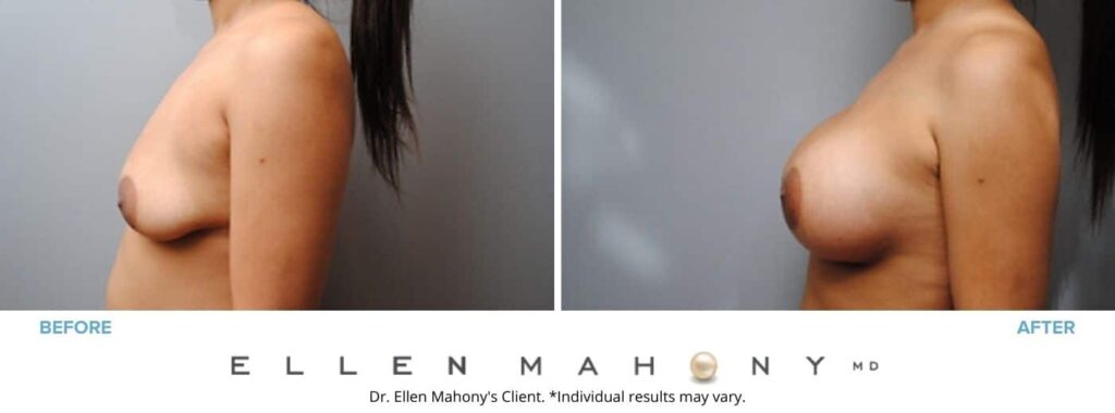 Before and After Image: Case #2847 - left-side