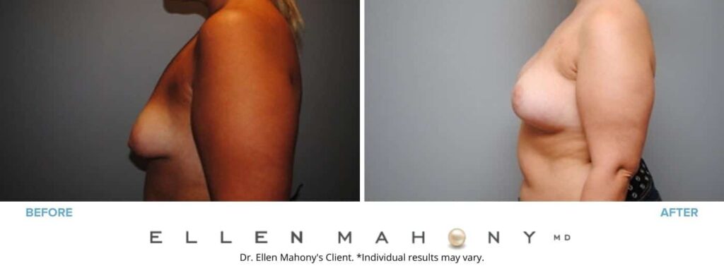 Before and After Image: Case #2854 - left-side