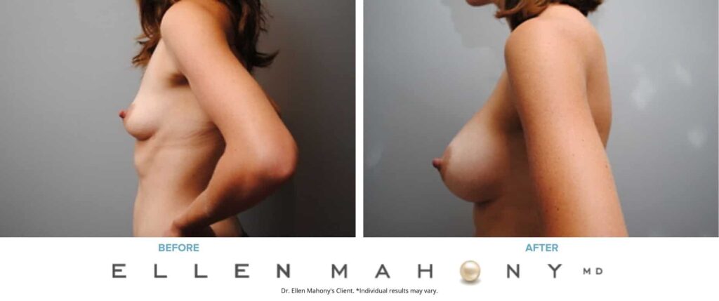 Before and After Image: Case #2891 - left-side