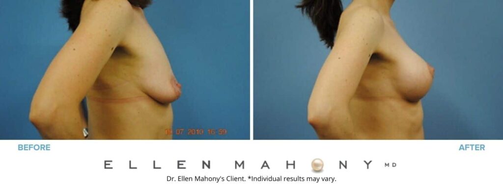 Before and After Image: Case #3053 - right-side