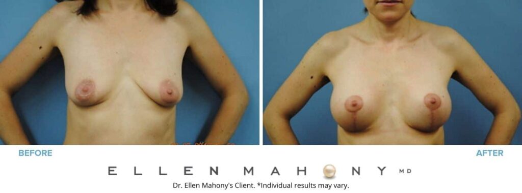 Before and After Image: Case #3053 - front