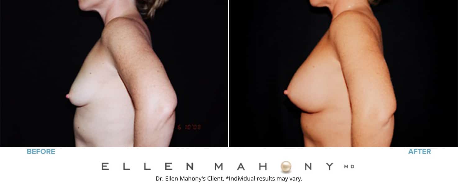 Before and After Image: Case #3153 - left-side