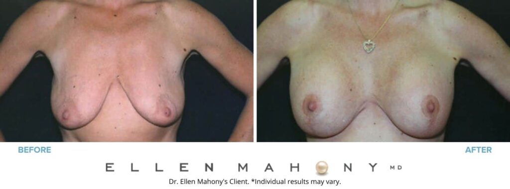 Before and After Image: Case #3167 - front