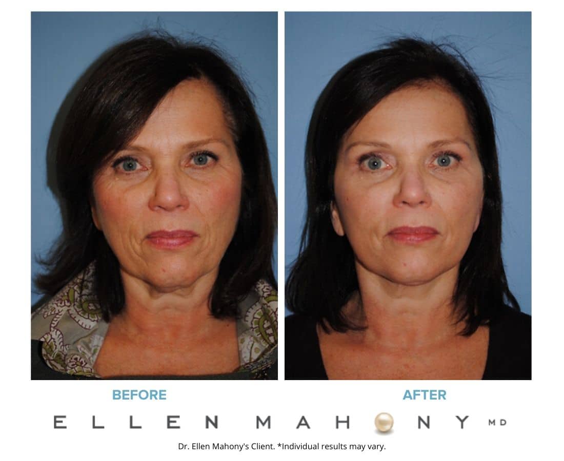Before and After Image: Case #3216 - front