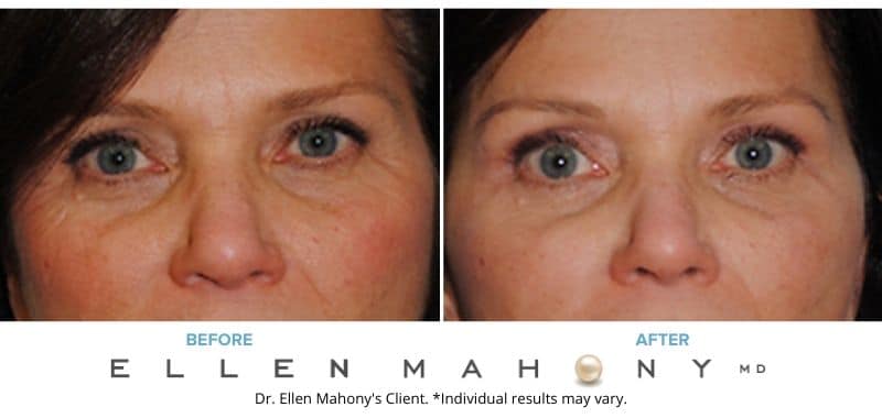 Before and After Image: Case #3216 - front