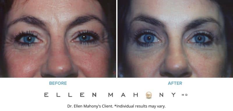 Before and After Image: Case #3225 - front
