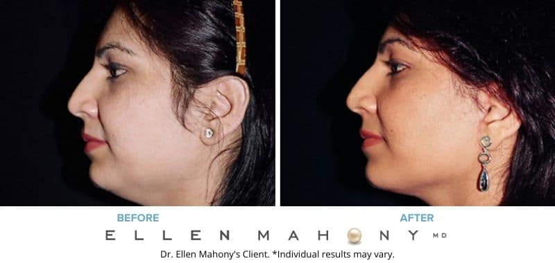 Before and After Image: Case #3228 - left-side