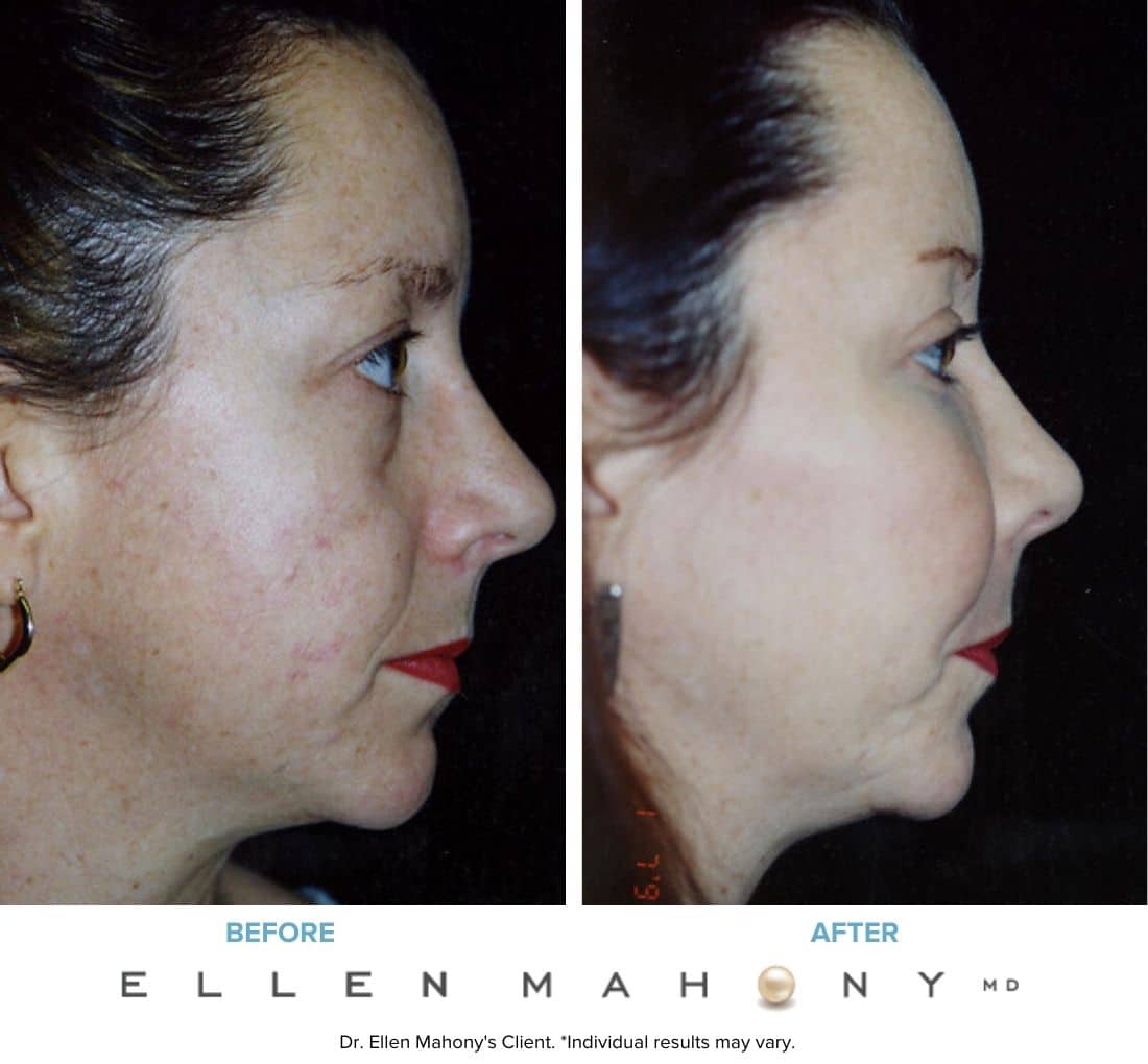 Before and After Image: Case #3235 - right-side