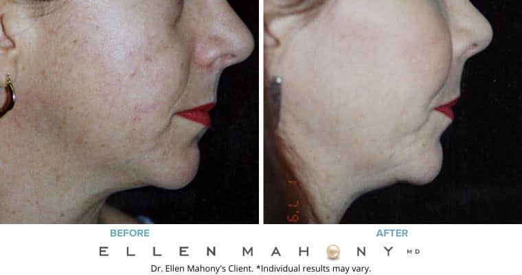 Before and After Image: Case #3235 - right-side