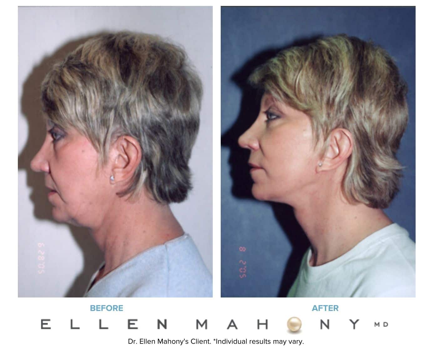 Before and After Image: Case #3238 - left-side