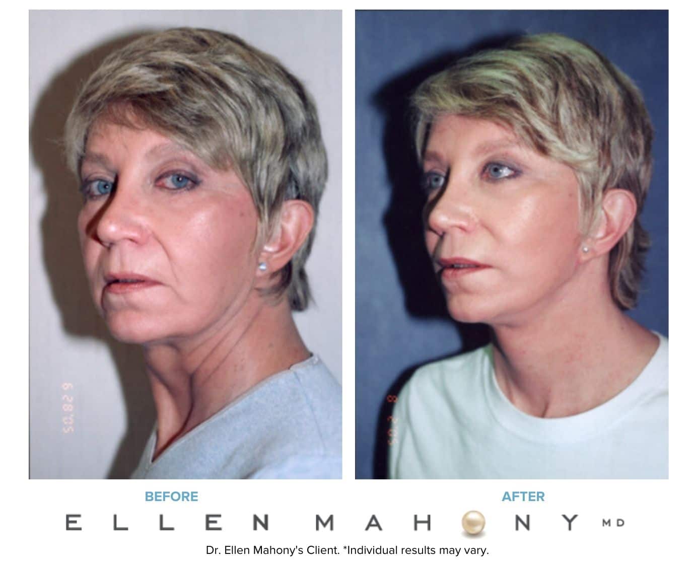 Before and After Image: Case #3238 - left-front-oblique