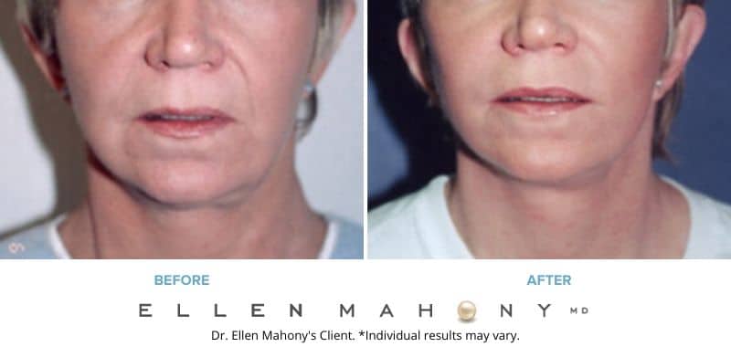 Before and After Image: Case #3238 - front