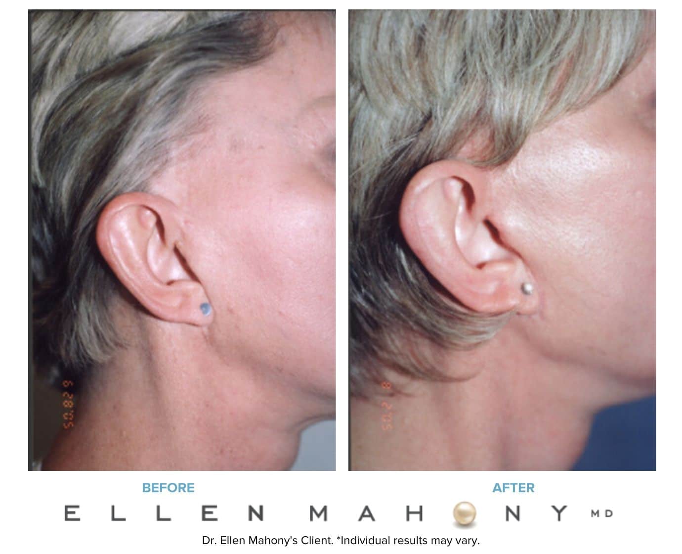 Before and After Image: Case #3238 - right-side