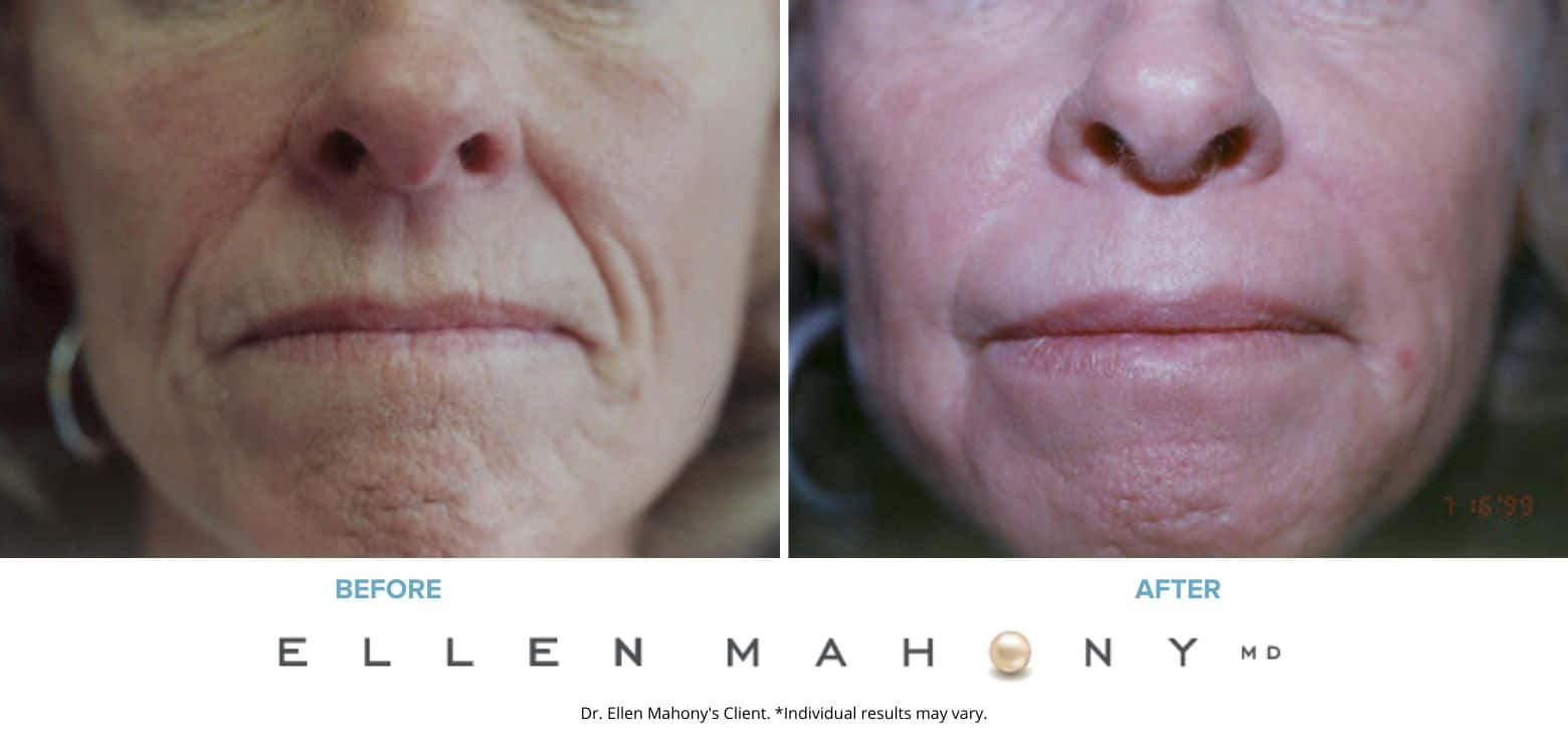 Before and After Image: Case #3249 - front