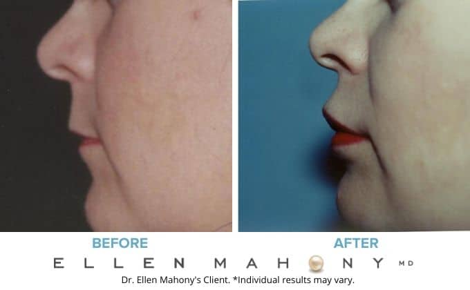 Before and After Image: Case #3254 - left-side