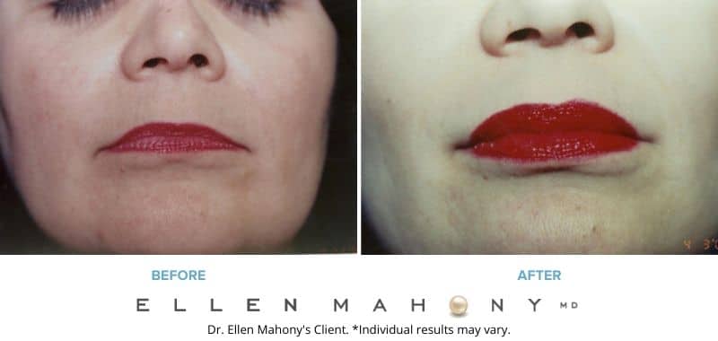 Before and After Image: Case #3254 - front