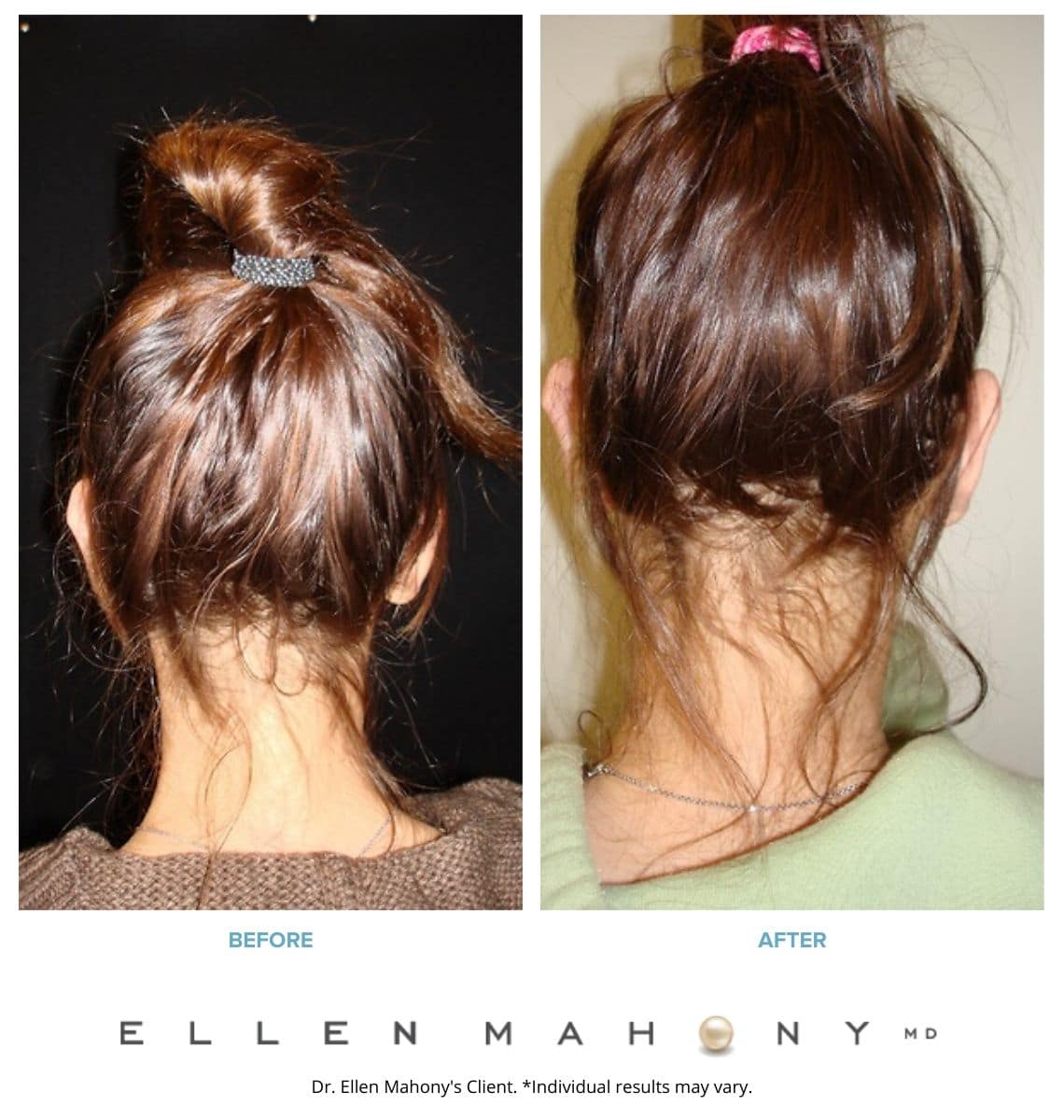 Before and After Image: Case #3258 - back
