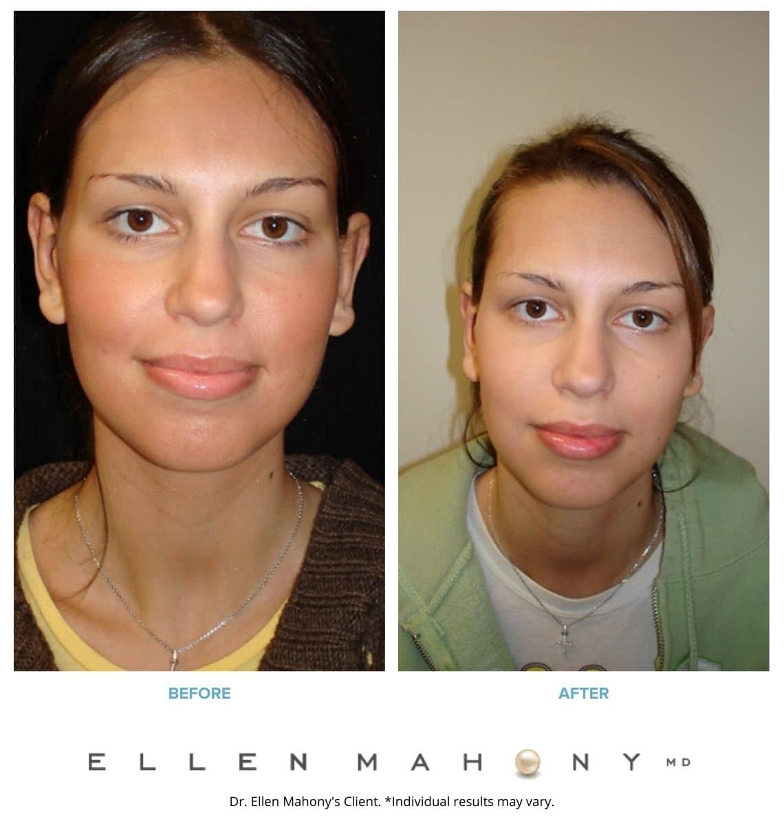 Before and After Image: Case #3258 - front