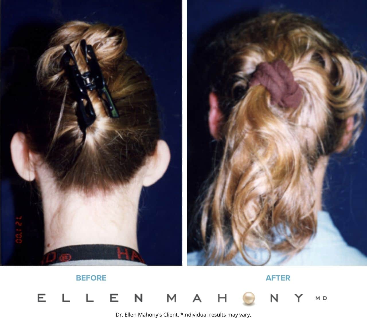 Before and After Image: Case #3264 - back