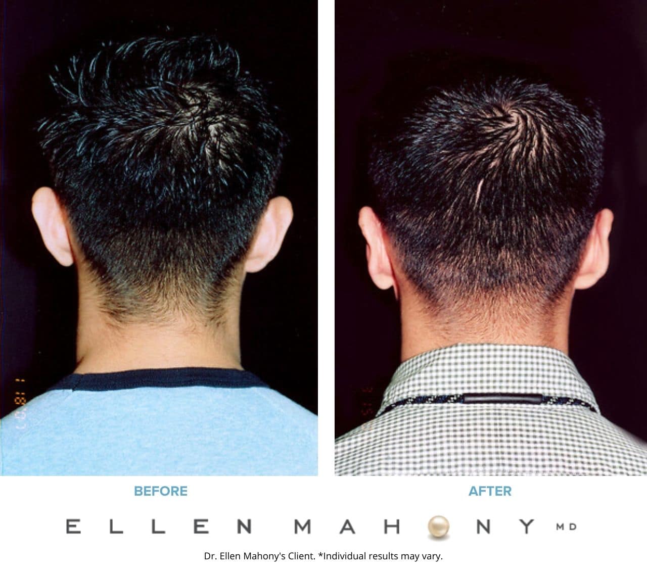 Before and After Image: Case #3267 - back
