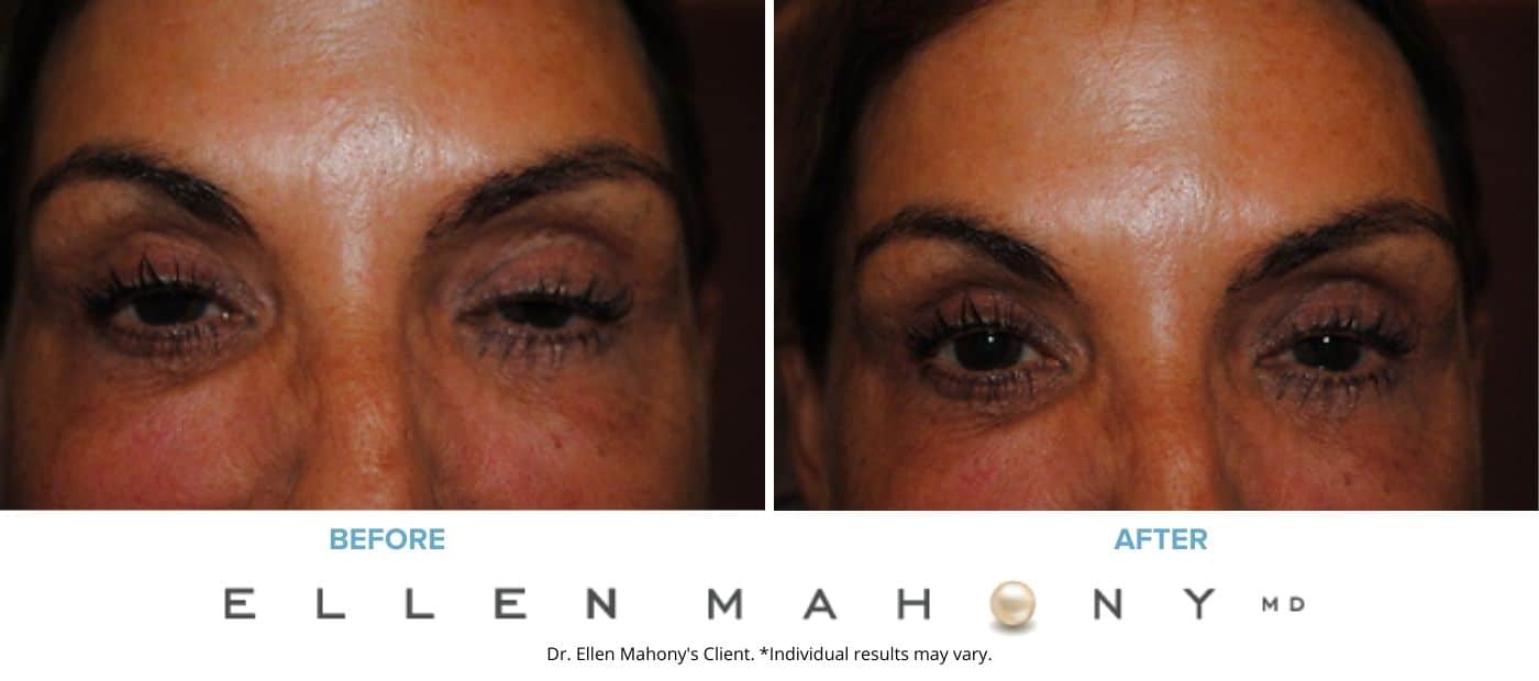 Before and After Image: Case #3281 - front