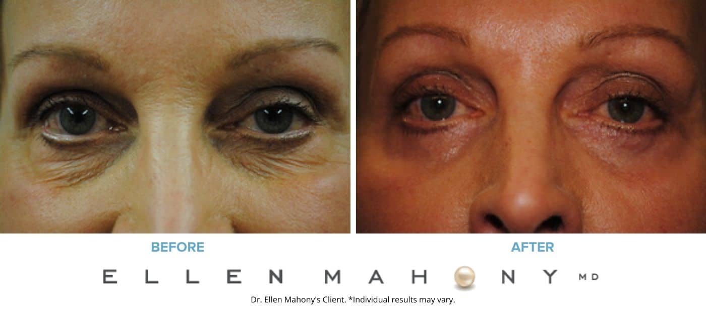 Before and After Image: Case #3284 - front