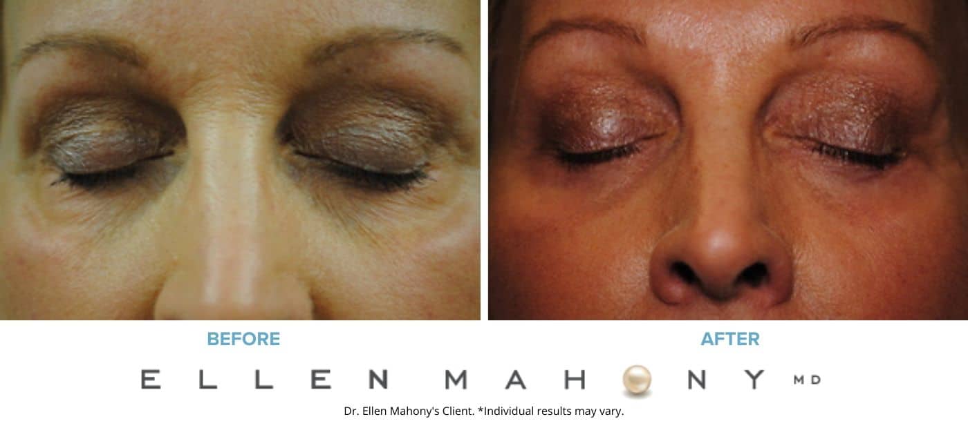 Before and After Image: Case #3284 - front