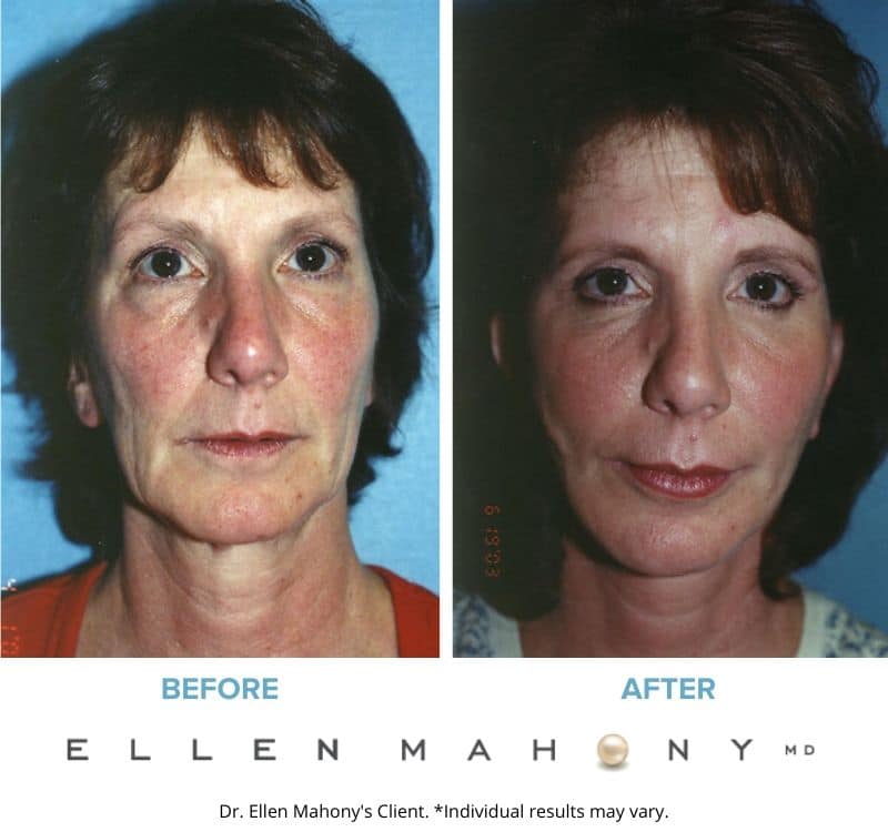 Before and After Image: Case #3291 - front