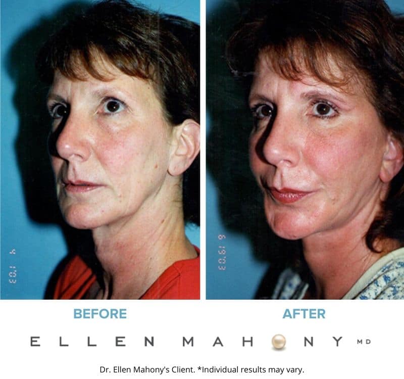 Before and After Image: Case #3291 - left-front-oblique
