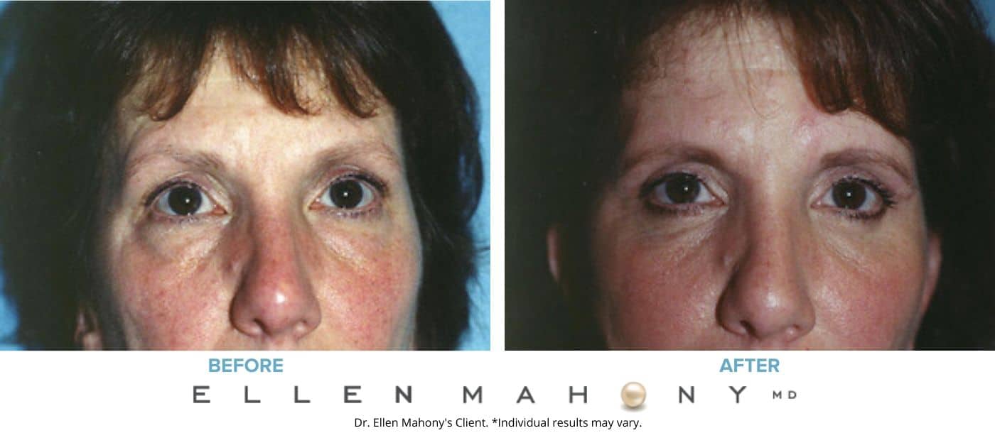 Before and After Image: Case #3291 - front