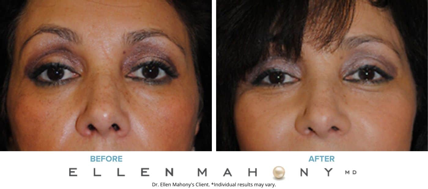 Before and After Image: Case #3306 - front