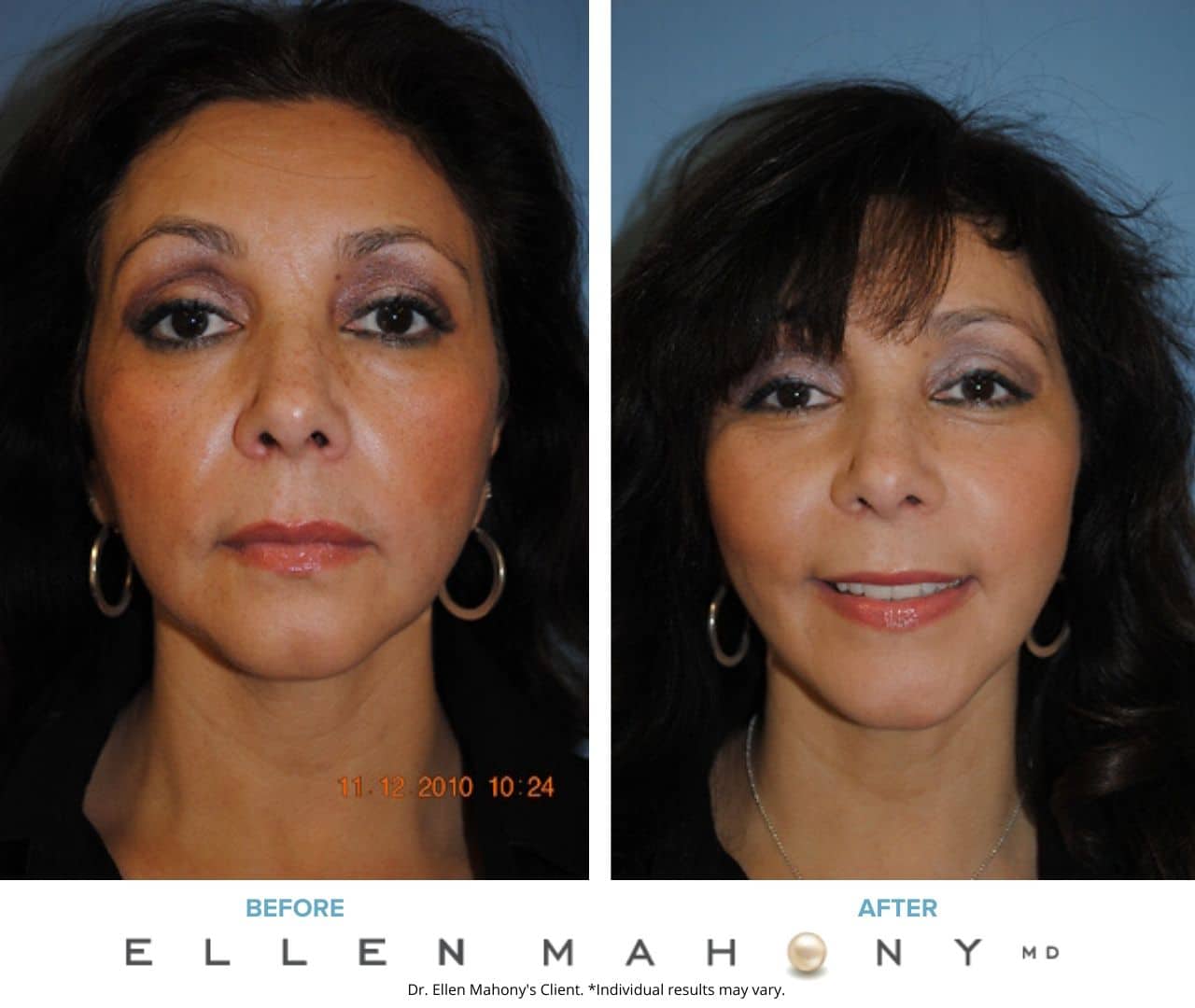 Before and After Image: Case #3306 - front