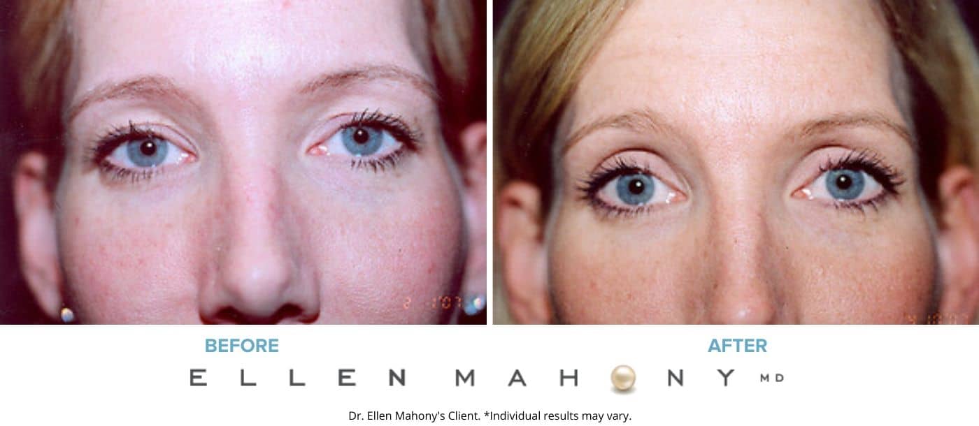 Before and After Image: Case #3309 - front