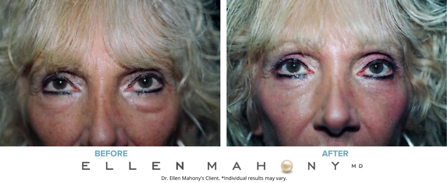 Before and After Image: Case #3312 - front