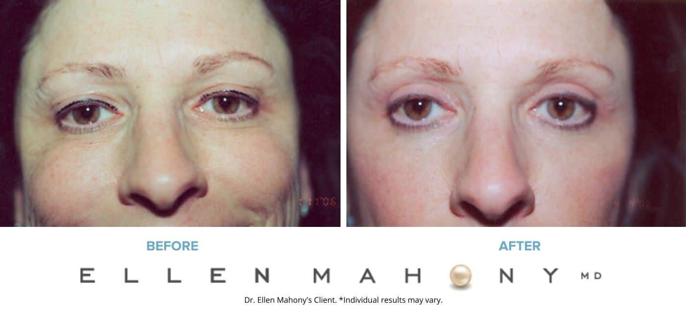 Before and After Image: Case #3321 - front