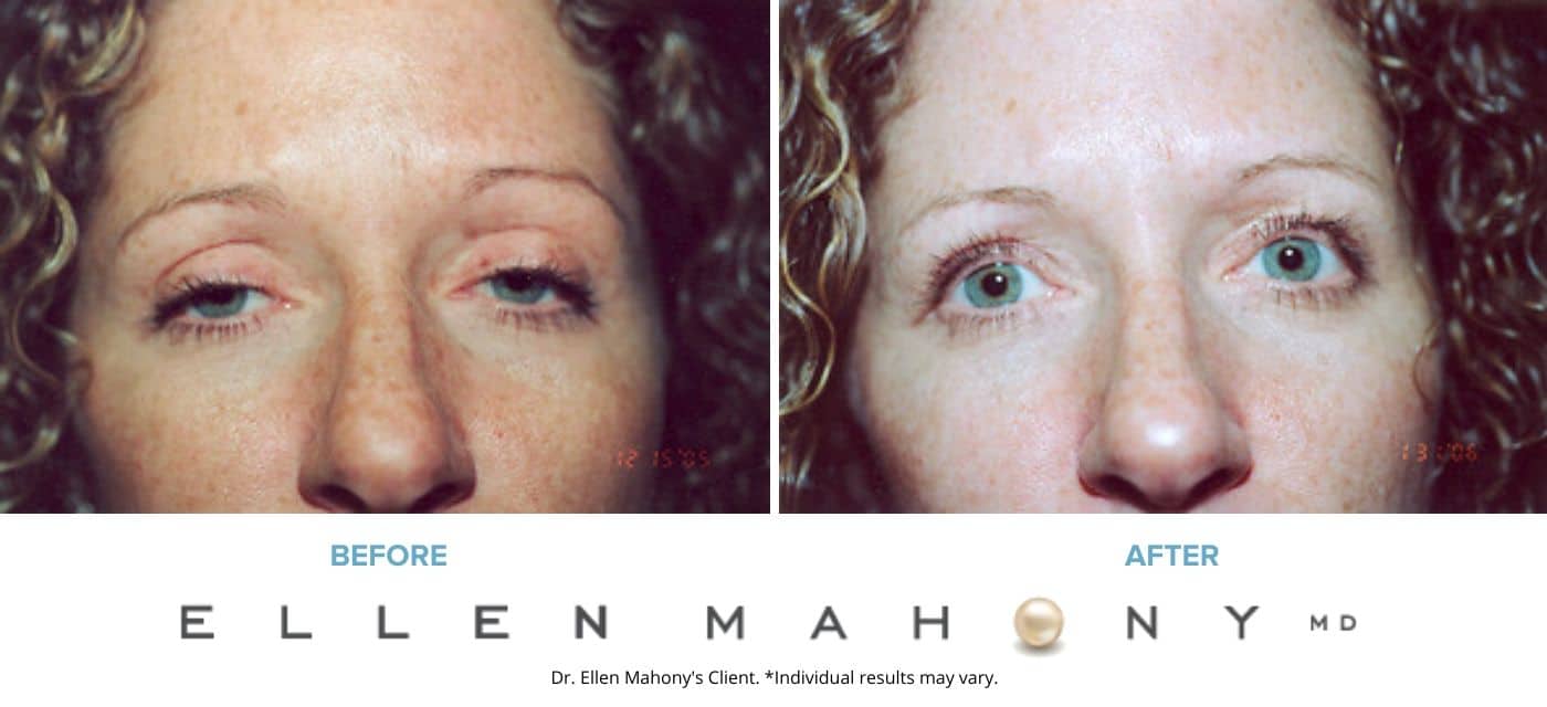 Before and After Image: Case #3324 - front
