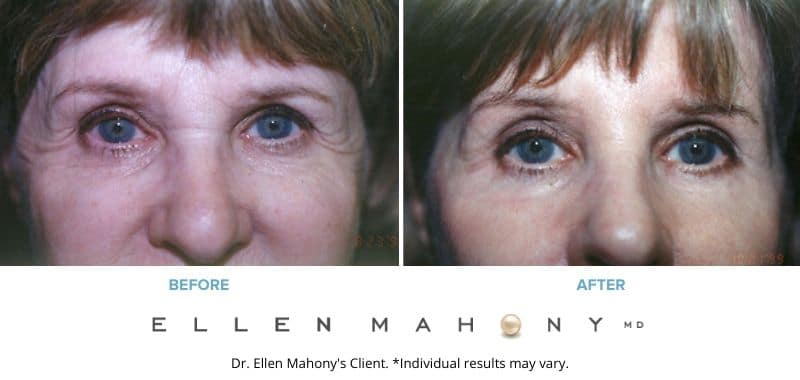 Before and After Image: Case #3327 - front