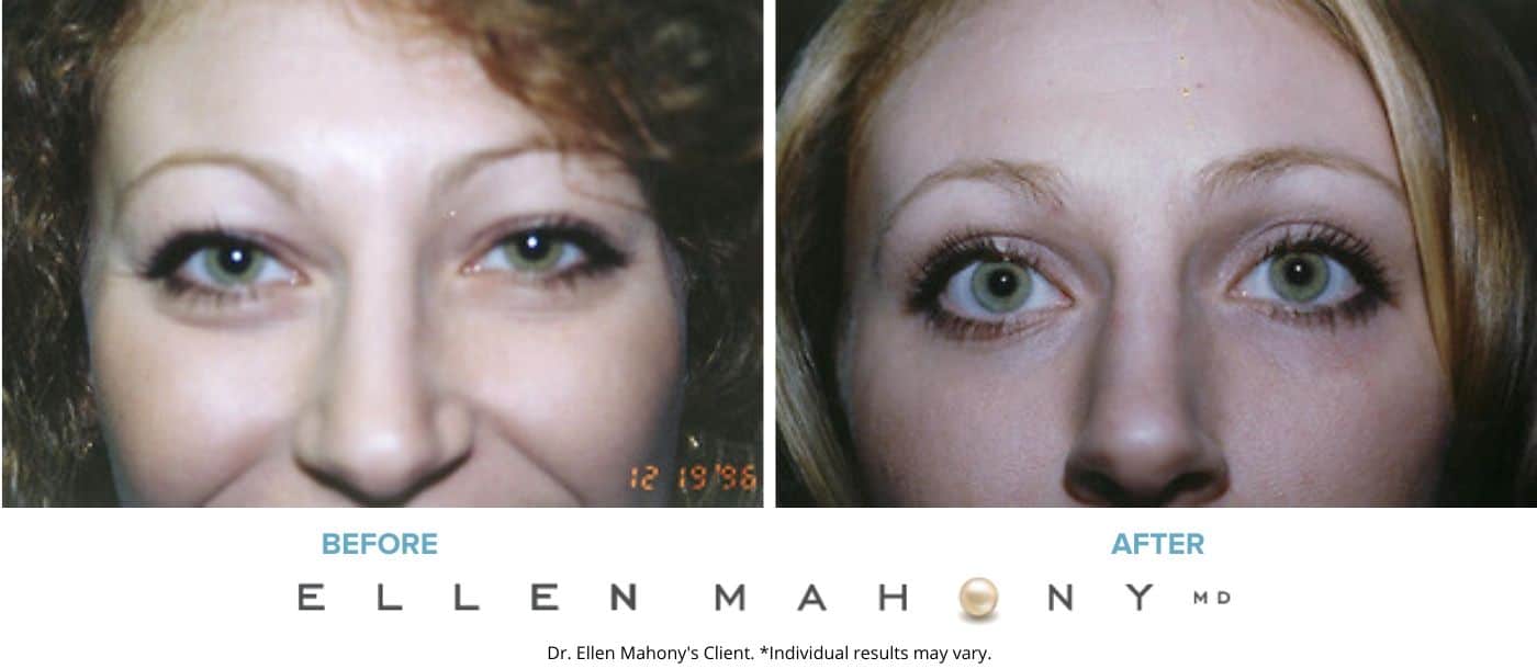 Before and After Image: Case #3333 - front