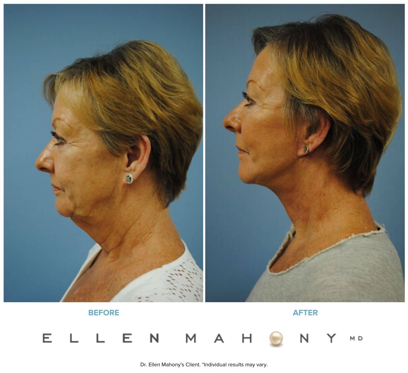Before and After Image: Case #3336 - left-side