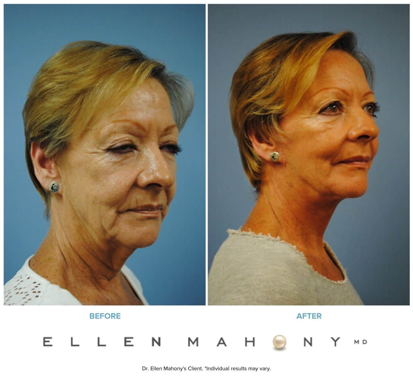Before and After Image: Case #3336 - right-front-oblique