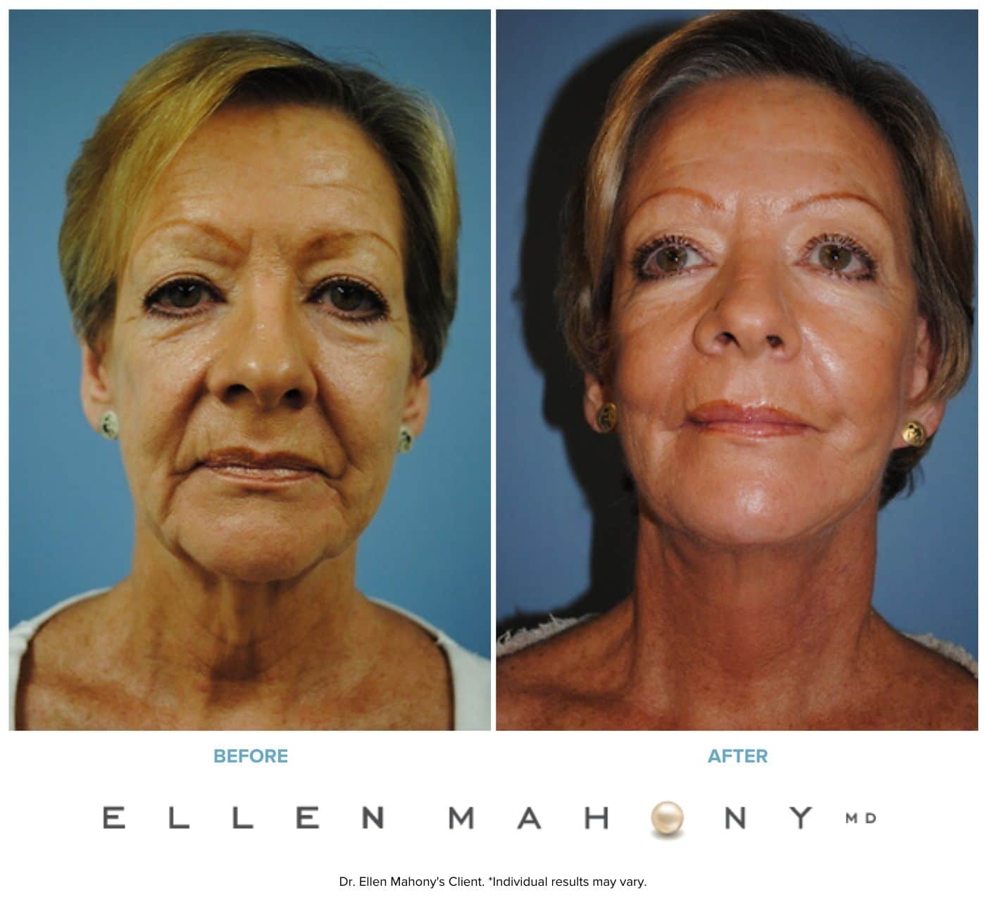 Before and After Image: Case #3336 - front