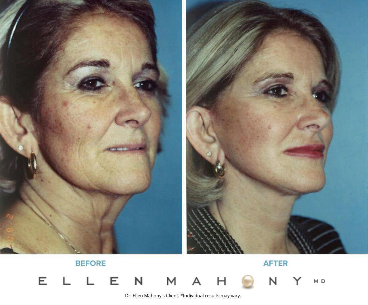 Before and After Image: Case #3343 - right-front-oblique