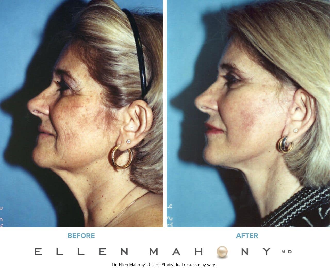 Before and After Image: Case #3343 - left-side