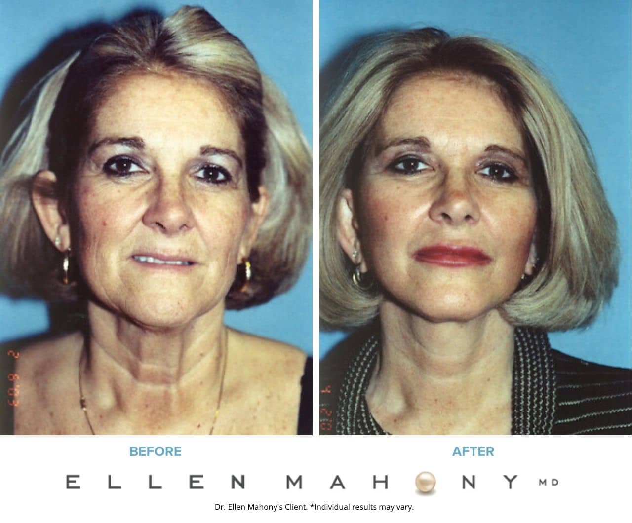 Before and After Image: Case #3343 - front