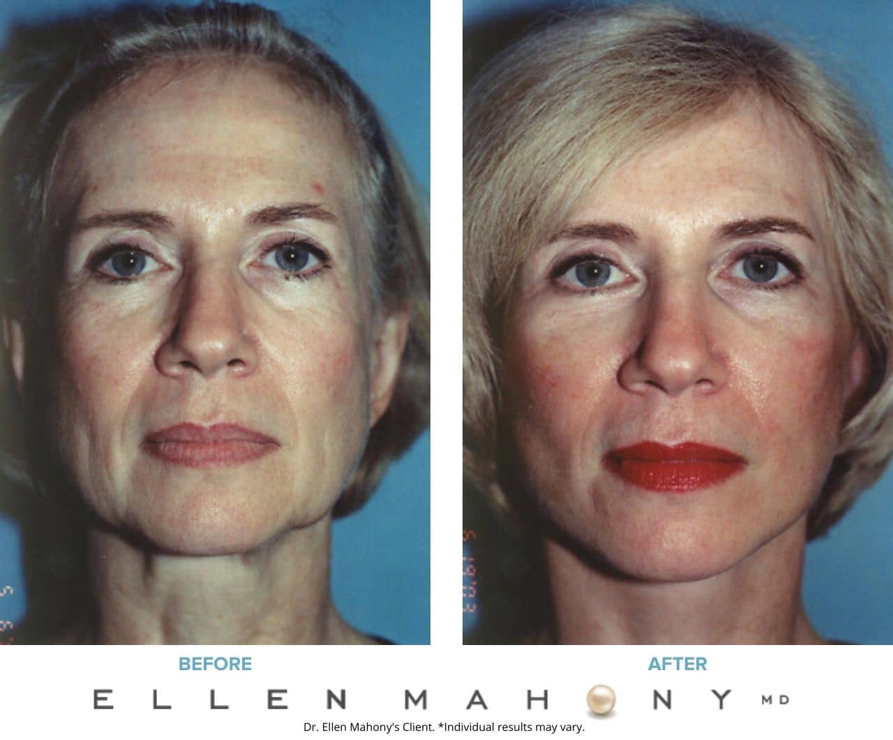 Before and After Image: Case #3350 - front