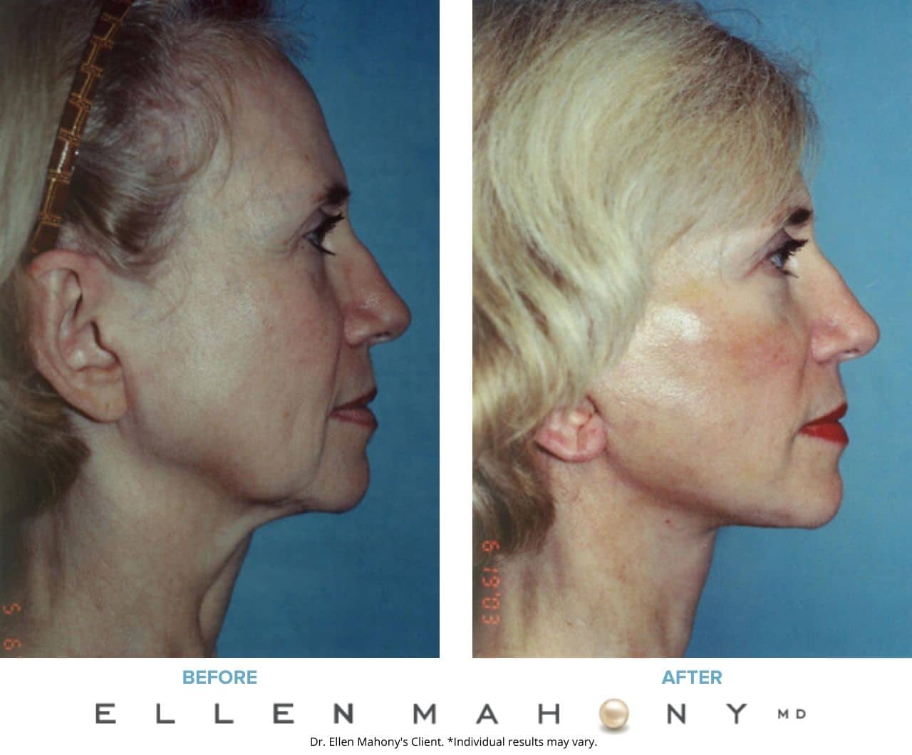 Before and After Image: Case #3350 - right-side