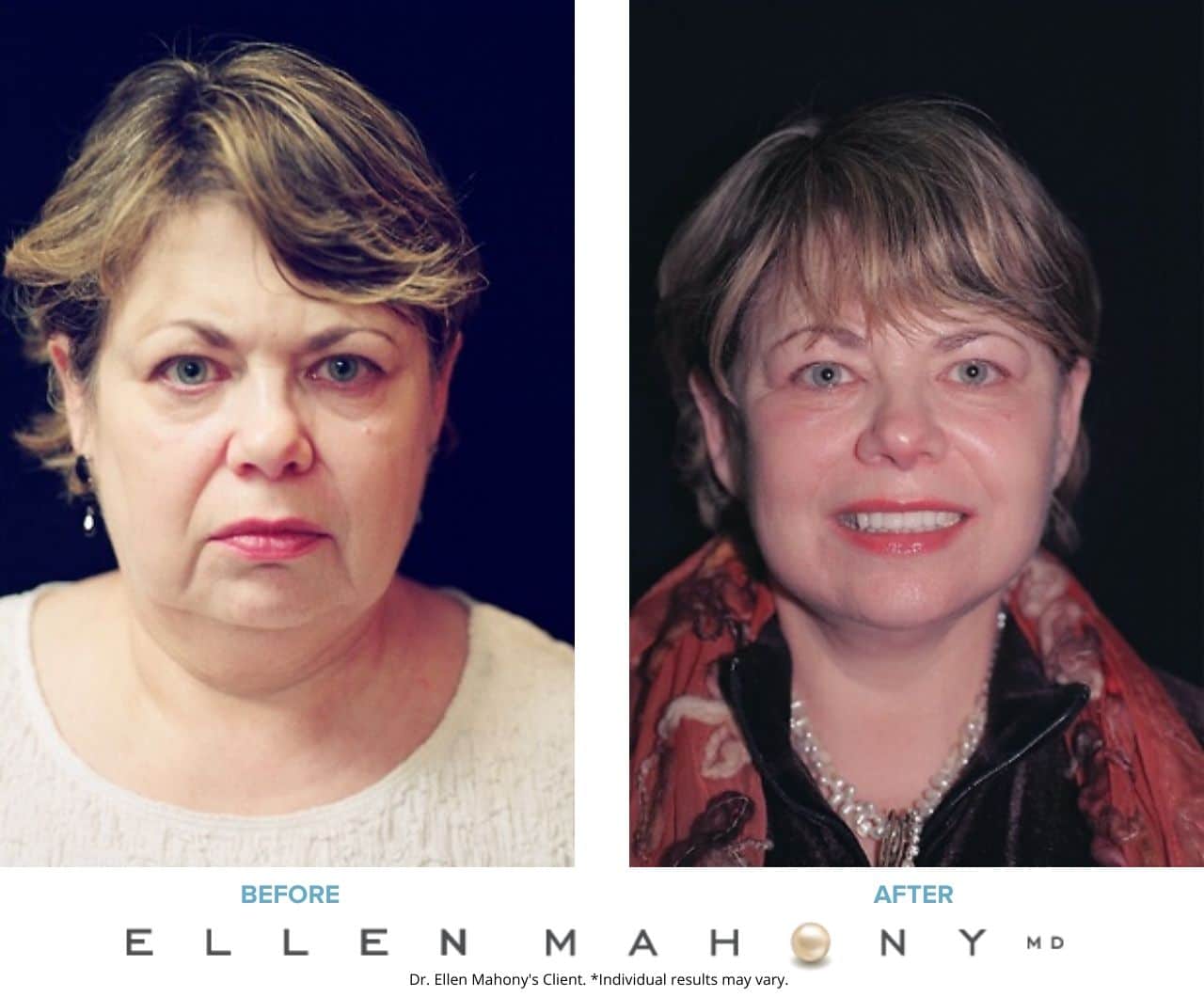 Before and After Image: Case #3357 - front